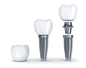 tooth implants in Sterling VA