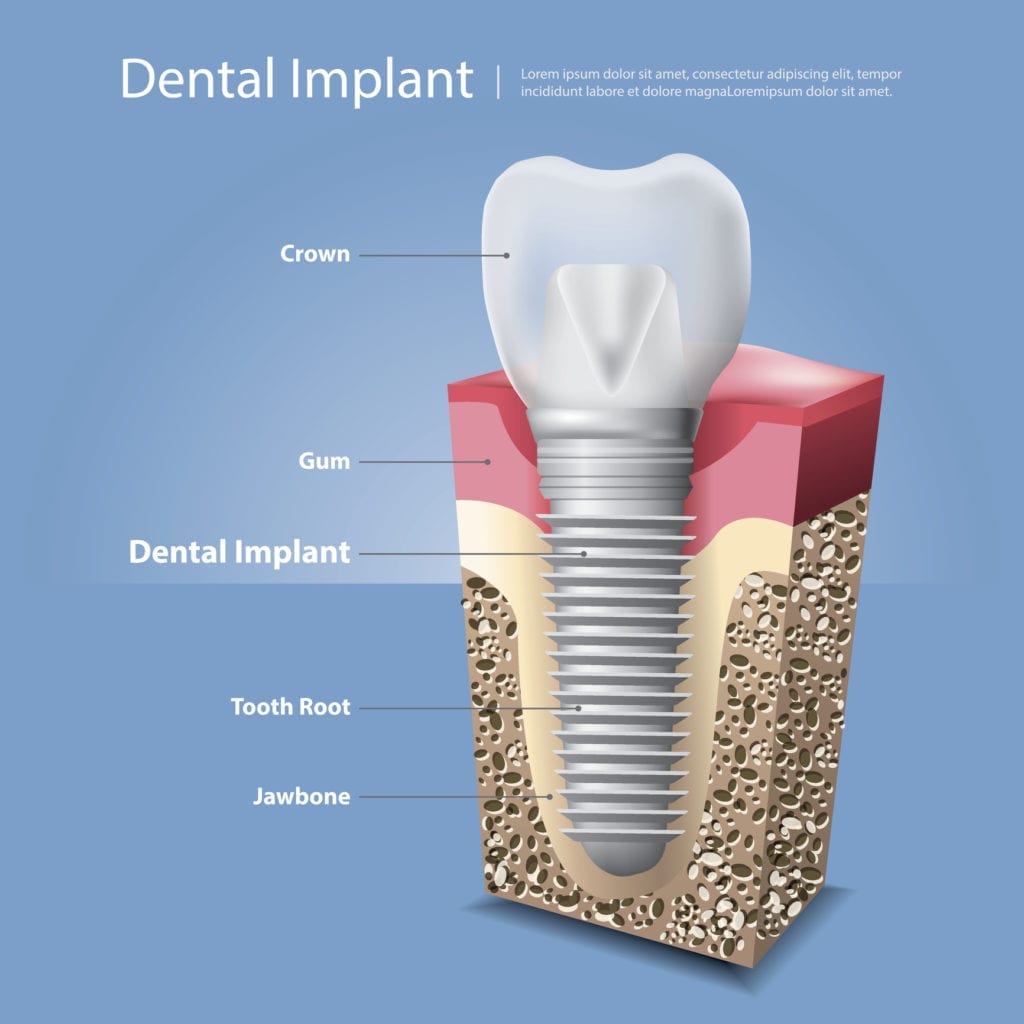 dental implants in Sterling VA