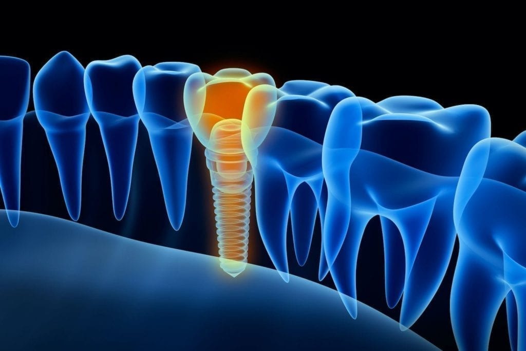 The dental implant process in sterling, virginia