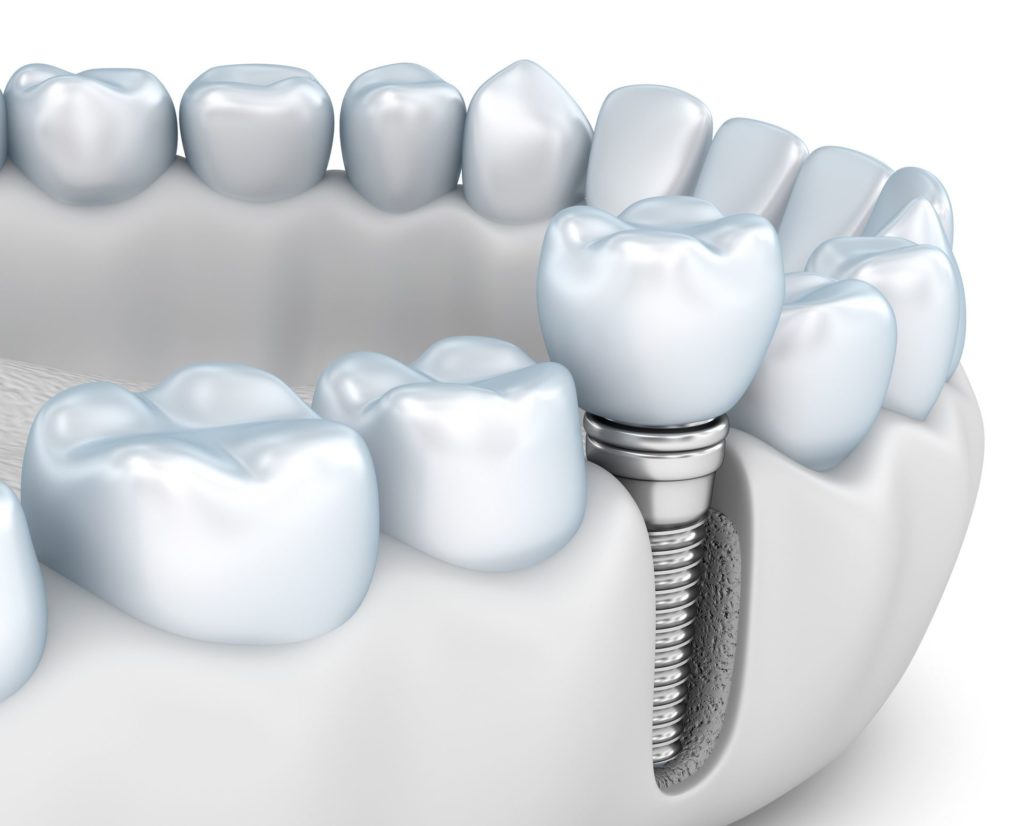 What Are Dental Implants? Sterling VA Implant Dentist 