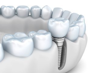 jawbone health and implant dentistry Sterling Virginia