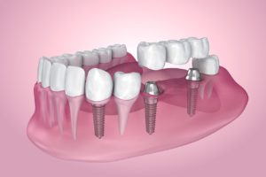 treat tooth loss Sterling Virginia