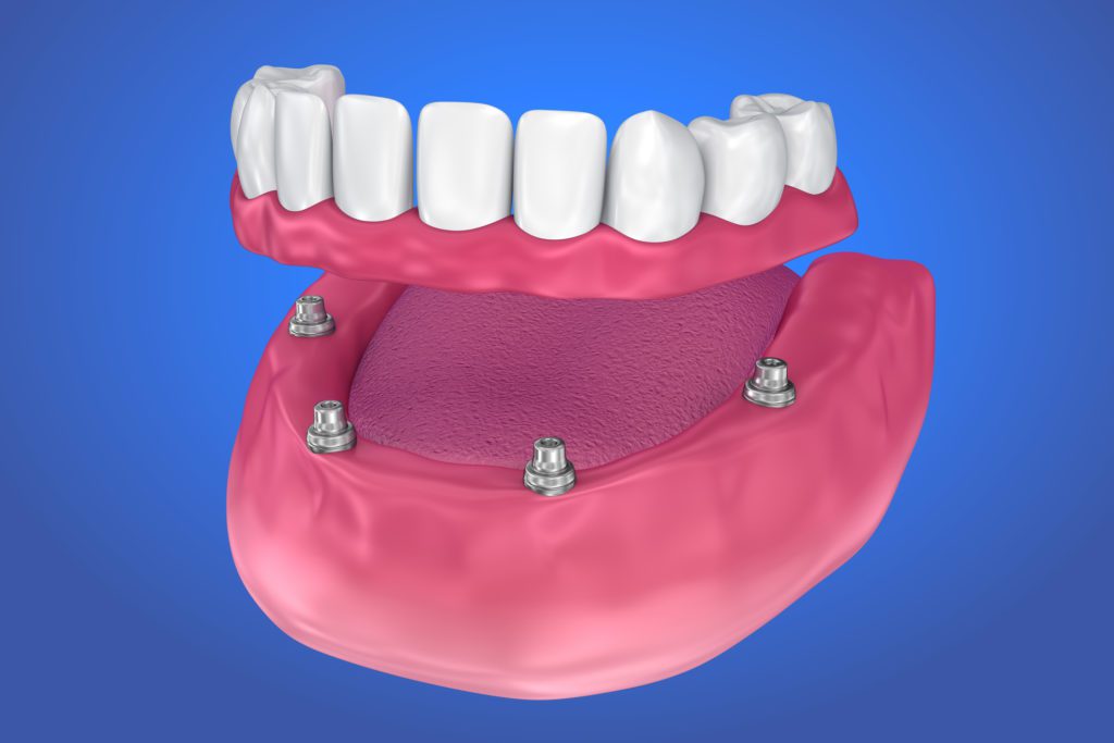 Denture Implants in Sterling VA