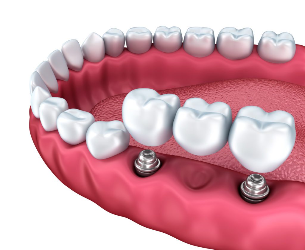 Implant Supported Bridge to replace Multiple Consecutive Missing Teeth in Sterling VA