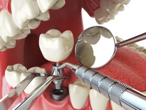 prosthetic tooth placement for dental implant