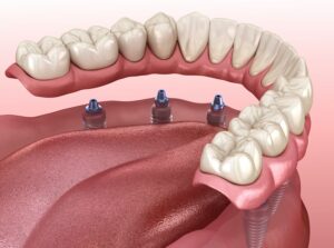 dentures replace missing teeth