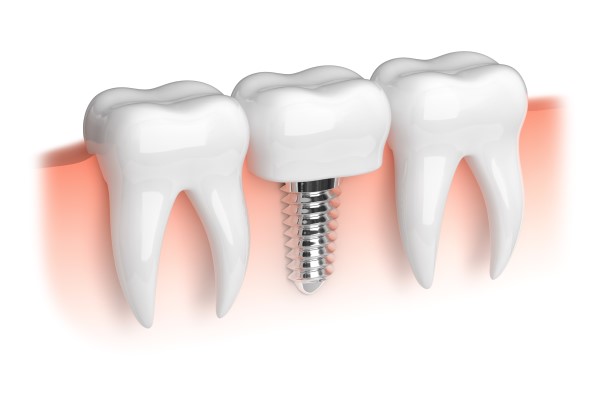 How To Know You Are A Candidate For Dental Implants