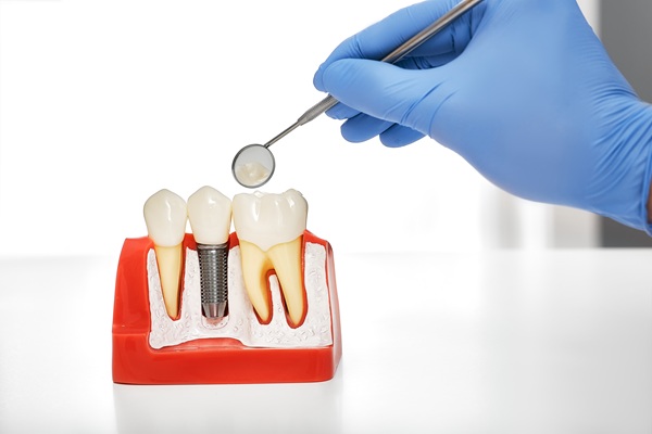 Implant Crowns Vs Traditional Crowns: Key Differences Explained